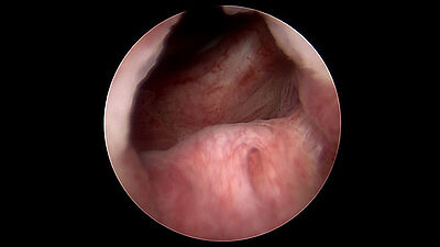 Endoscopic view during cystoscopy