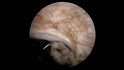 Endoscopic view during transurethral resection of the prostate